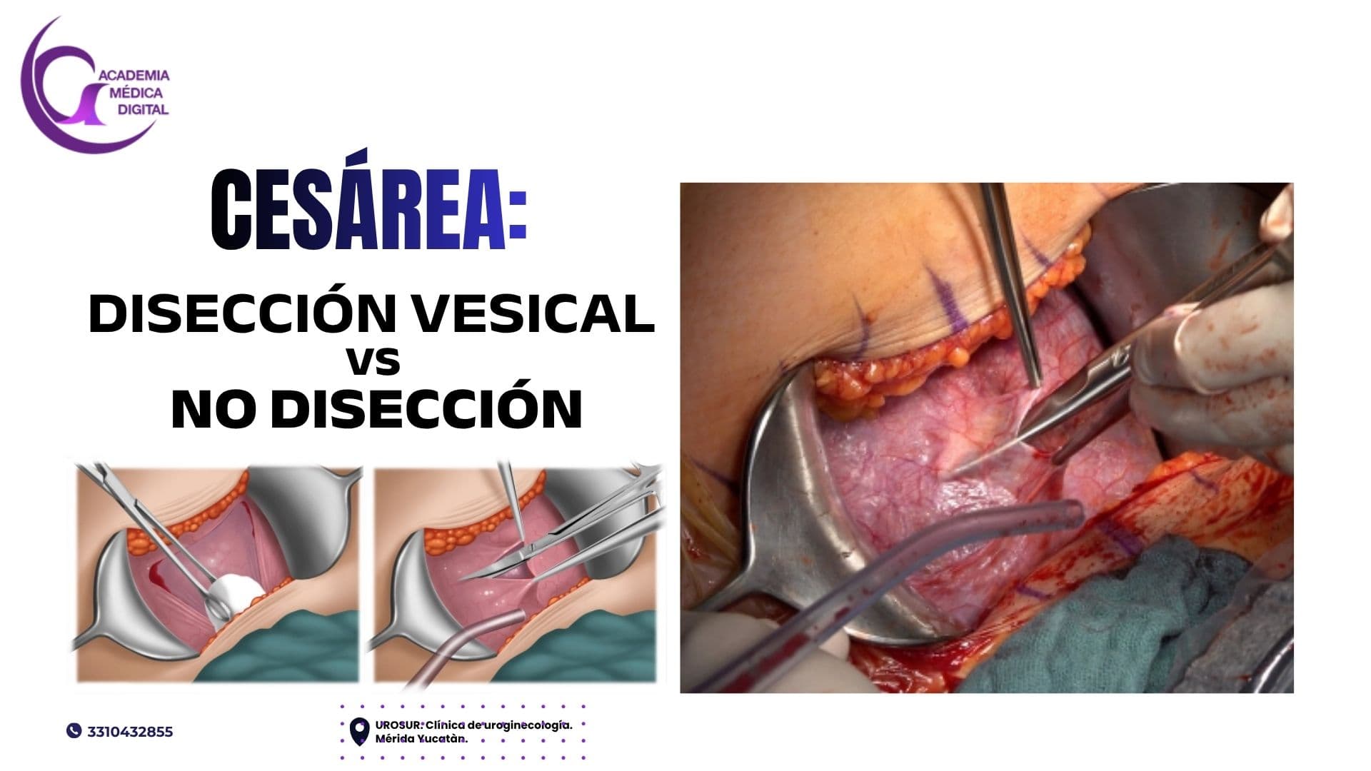 DESECCIÓN VESICAL Vs NO DISECCIÓN EN CESÁREA: 