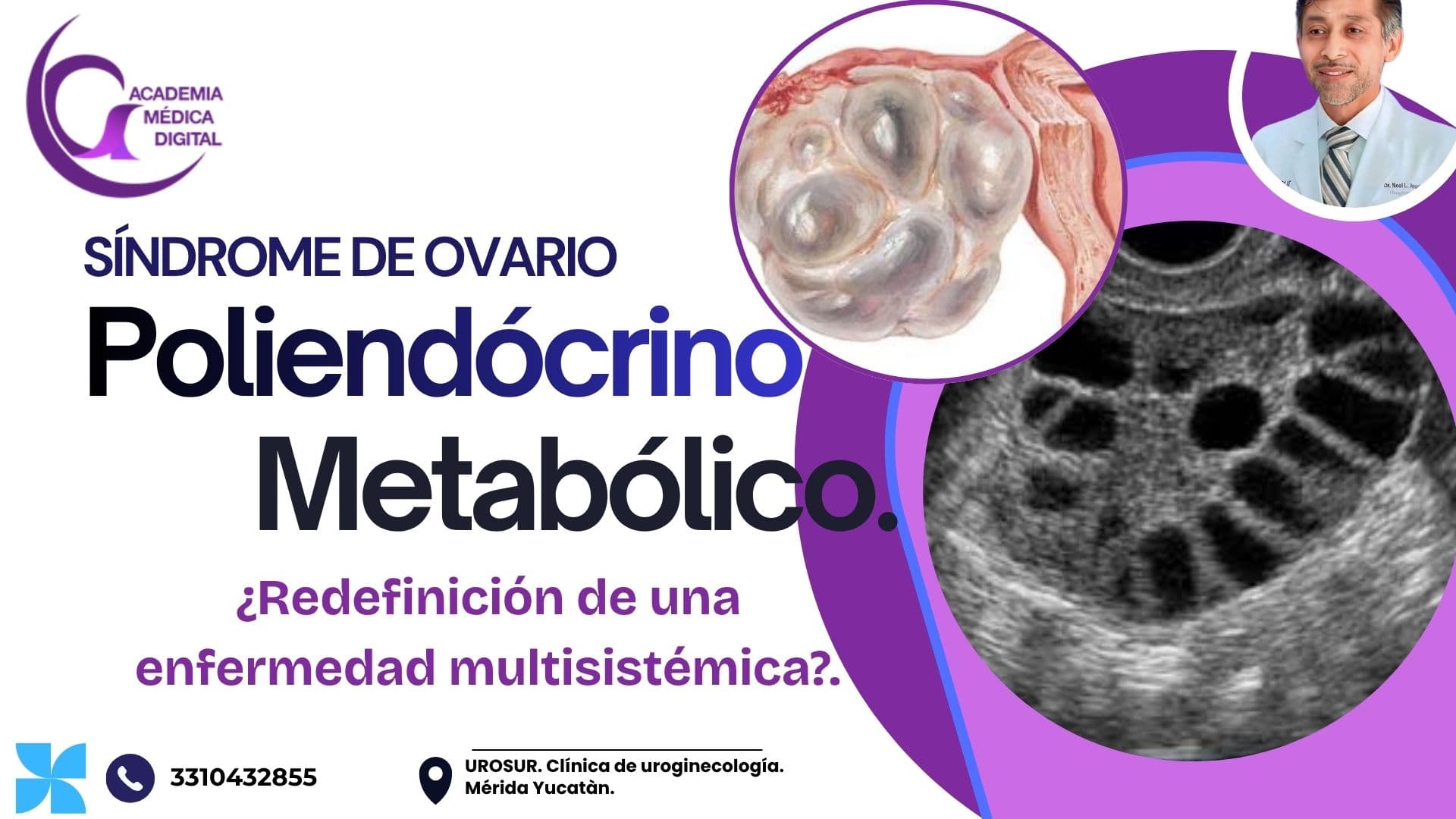 SÍNDROME OVÁRICO METABÓLICO POLIENDÓCRINO (PMOS): ¿Redefinición de una enfermedad multisistémica?.  