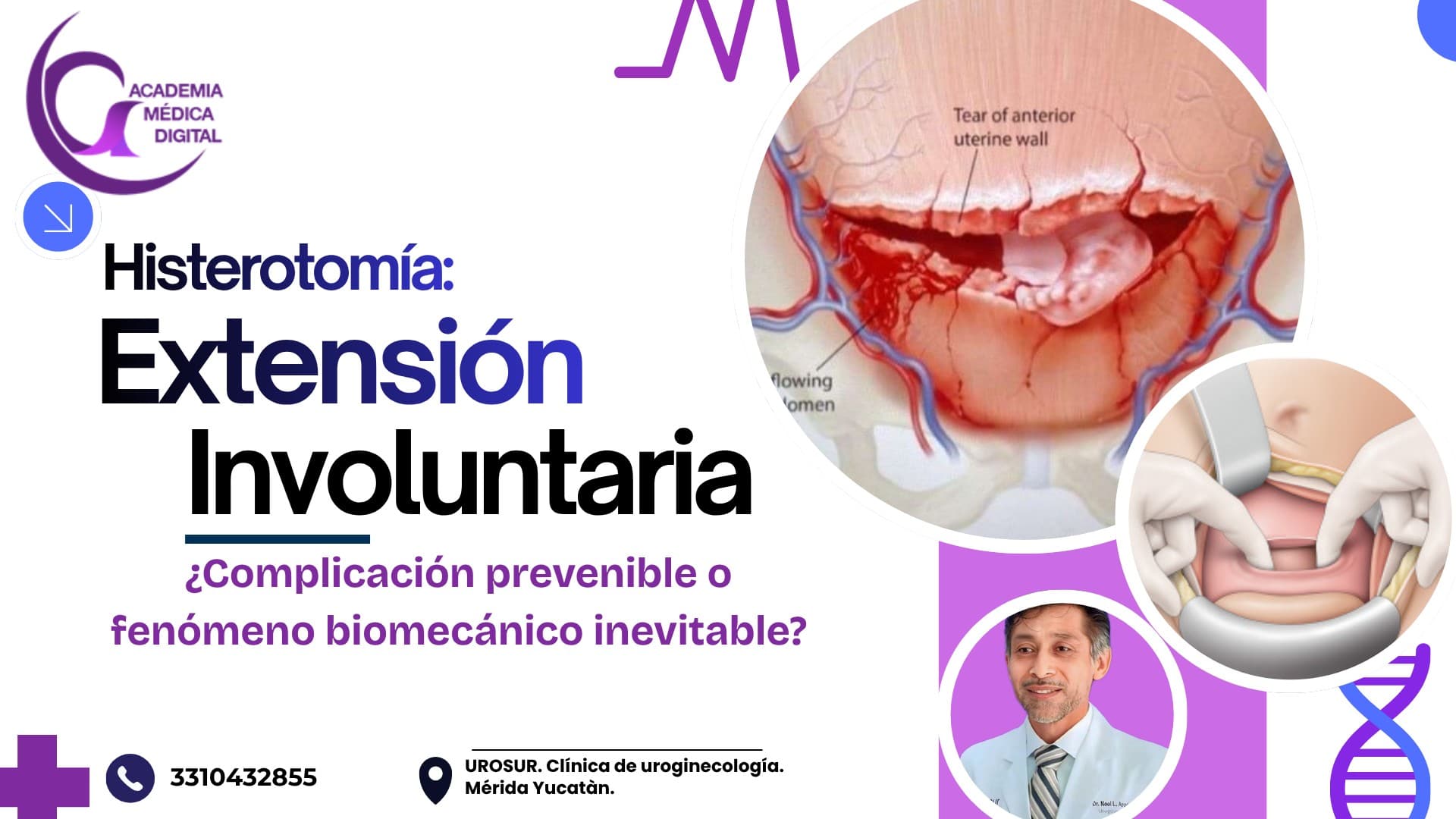 HISTEROTOMÍA EN CESÁREA, EXTENSION INVOLUNTARIA: ¿Complicación prevenible o fenómeno biomecánico inevitable?